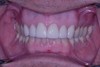 after dental procedure 1