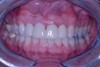 after dental procedure 3