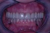 after dental procedure 4