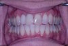 after dental procedure 6