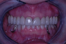 after dental procedure 9
