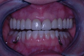after dental procedure 10