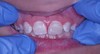 after dental procedure 11