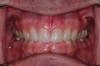 after dental procedure 13