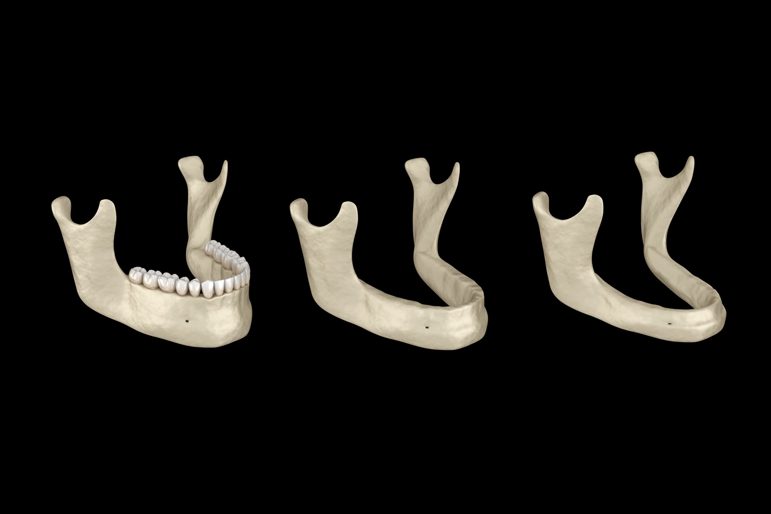 Mandibular Jaw, bone recession after losing teeth. Medically accurate dental 3D illustration