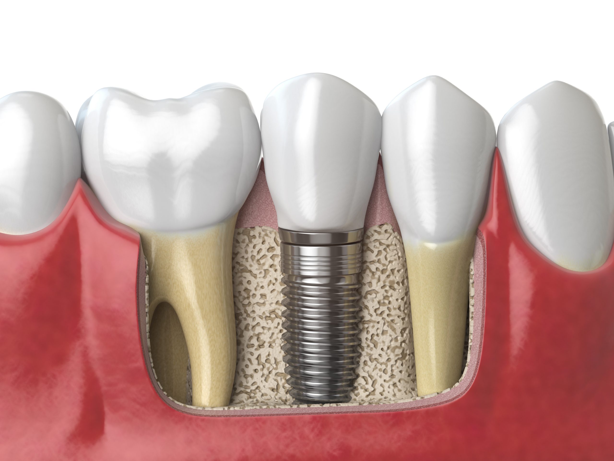 Anatomy of healthy teeth and tooth dental implant in human dentura. 3d illustration