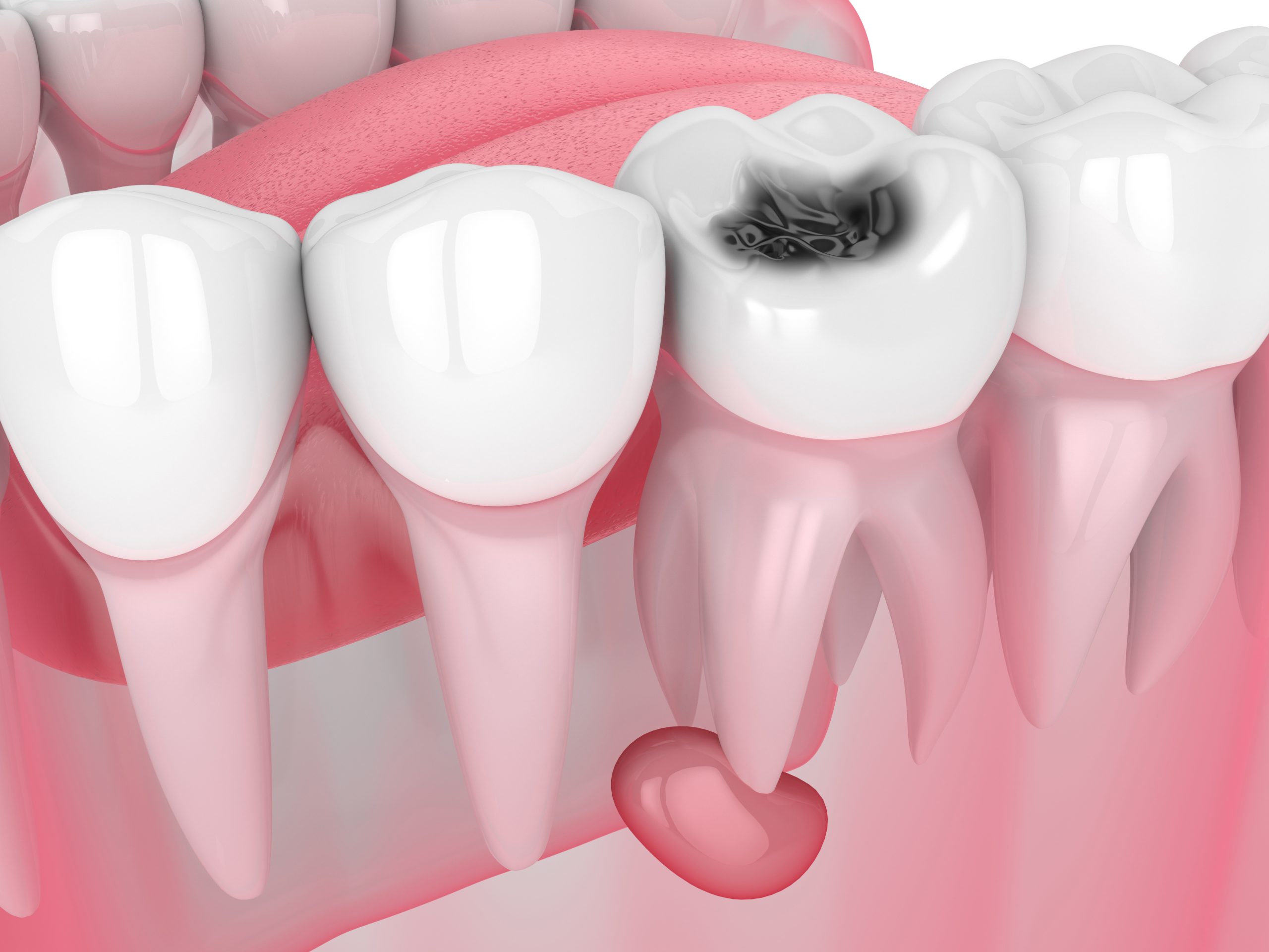 3d render of jaw with tooth cavity and cyst. Dental problem concept.