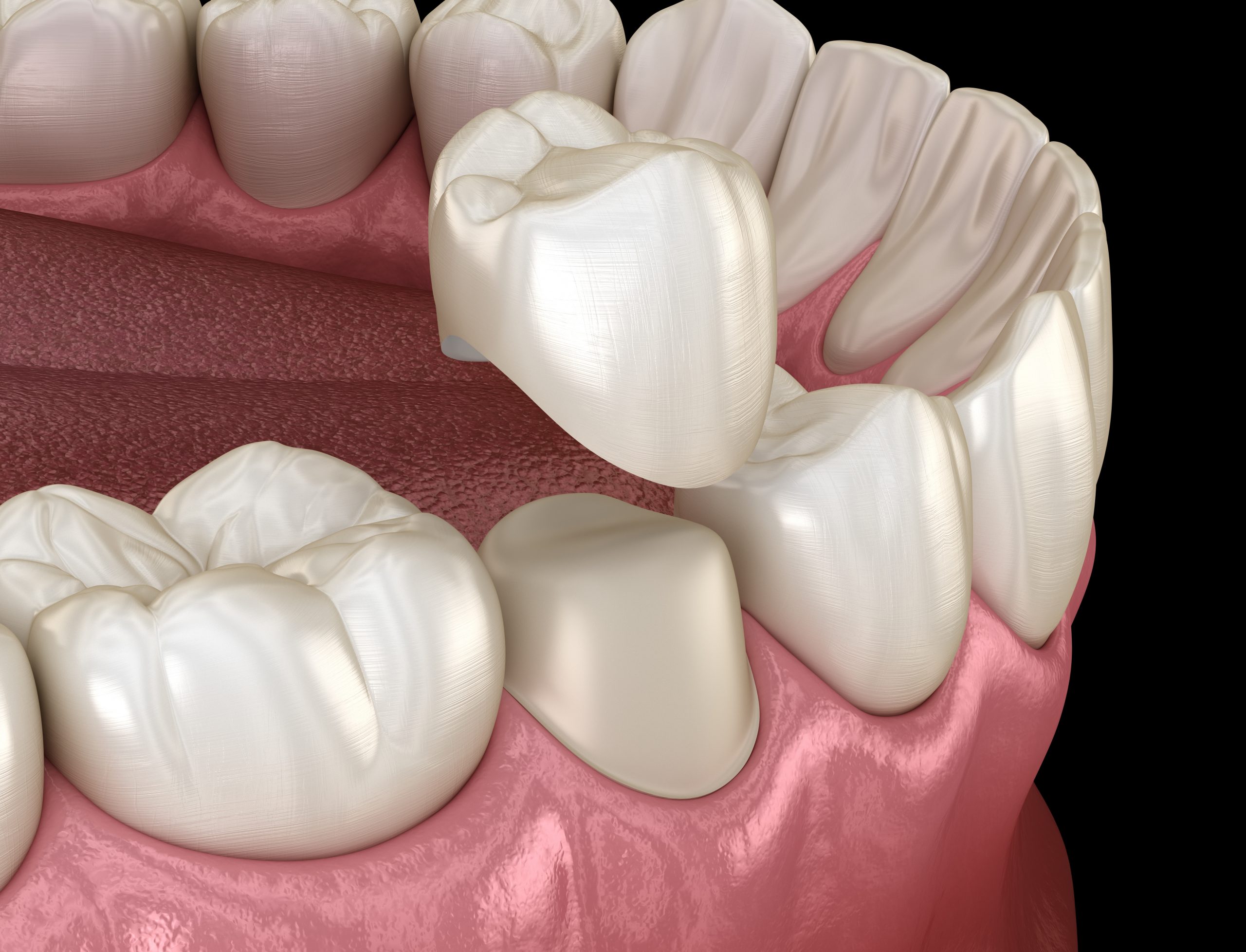 Dental crown premolar tooth assembly process. Medically accurate 3D illustration of human teeth treatment