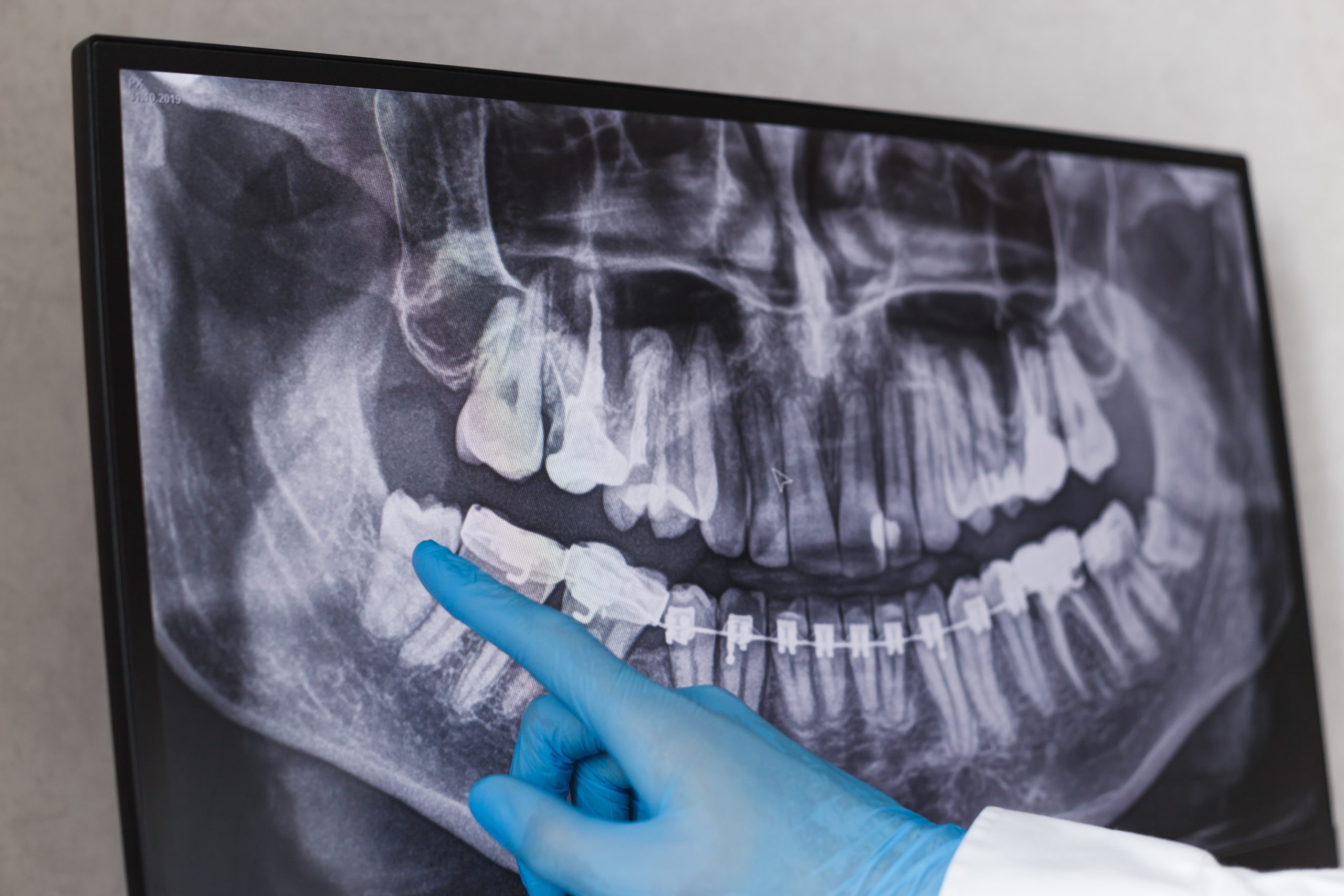 oral cancer screening