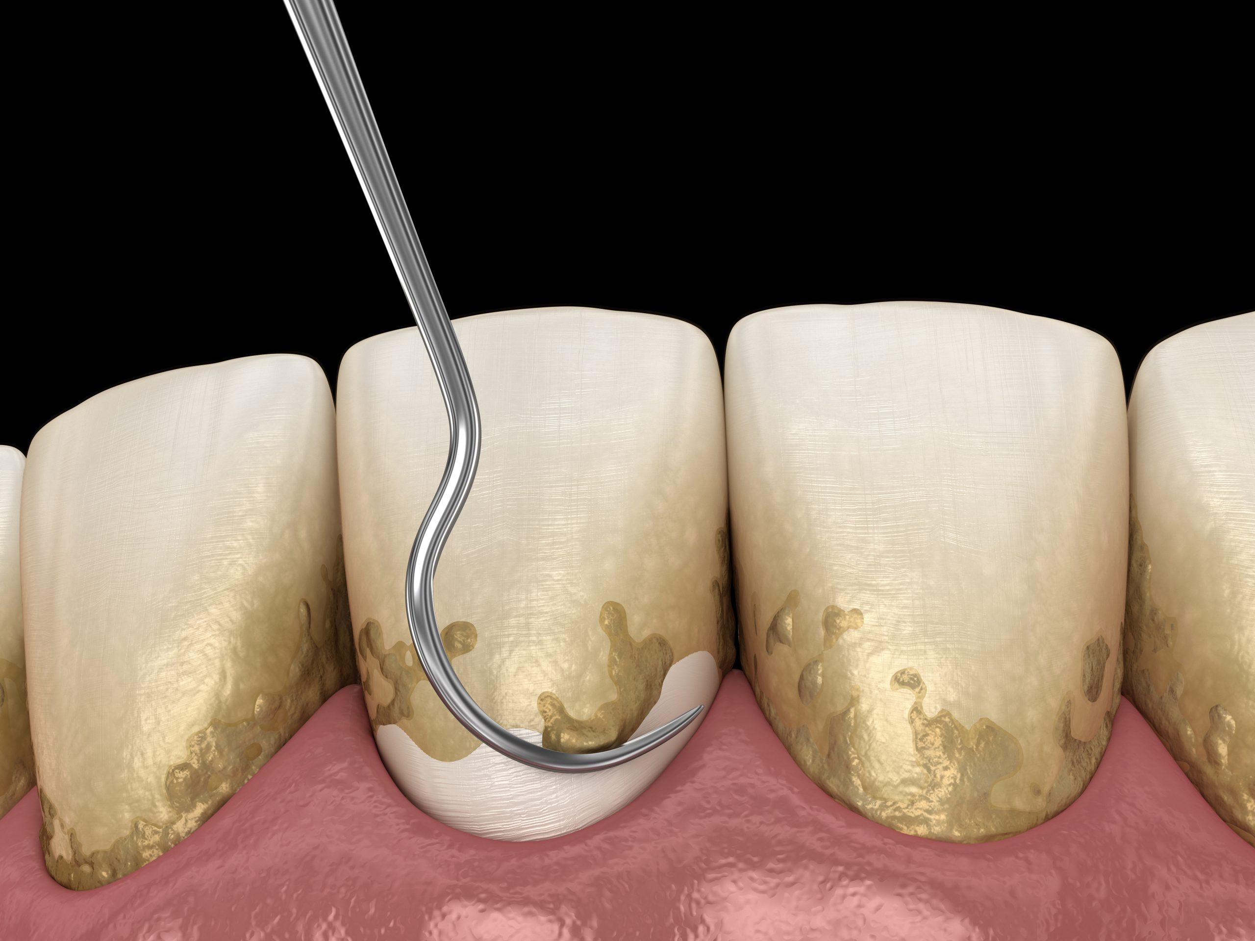 Oral hygiene: Scaling and root planing (conventional periodontal therapy). Medically accurate 3D illustration of human teeth treatment