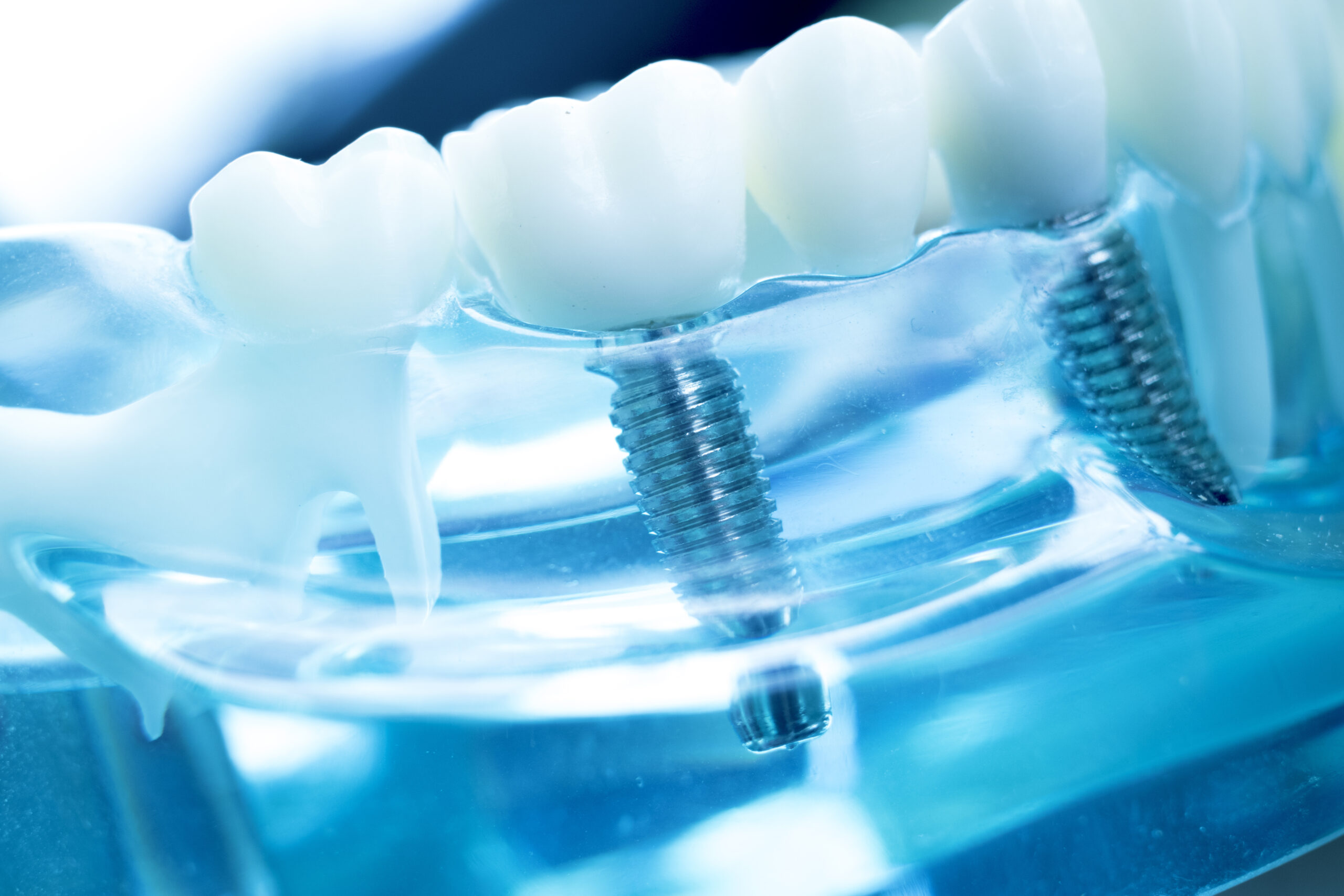 Dentist dental teeth teaching model showing titanium metal tooth implant screw.