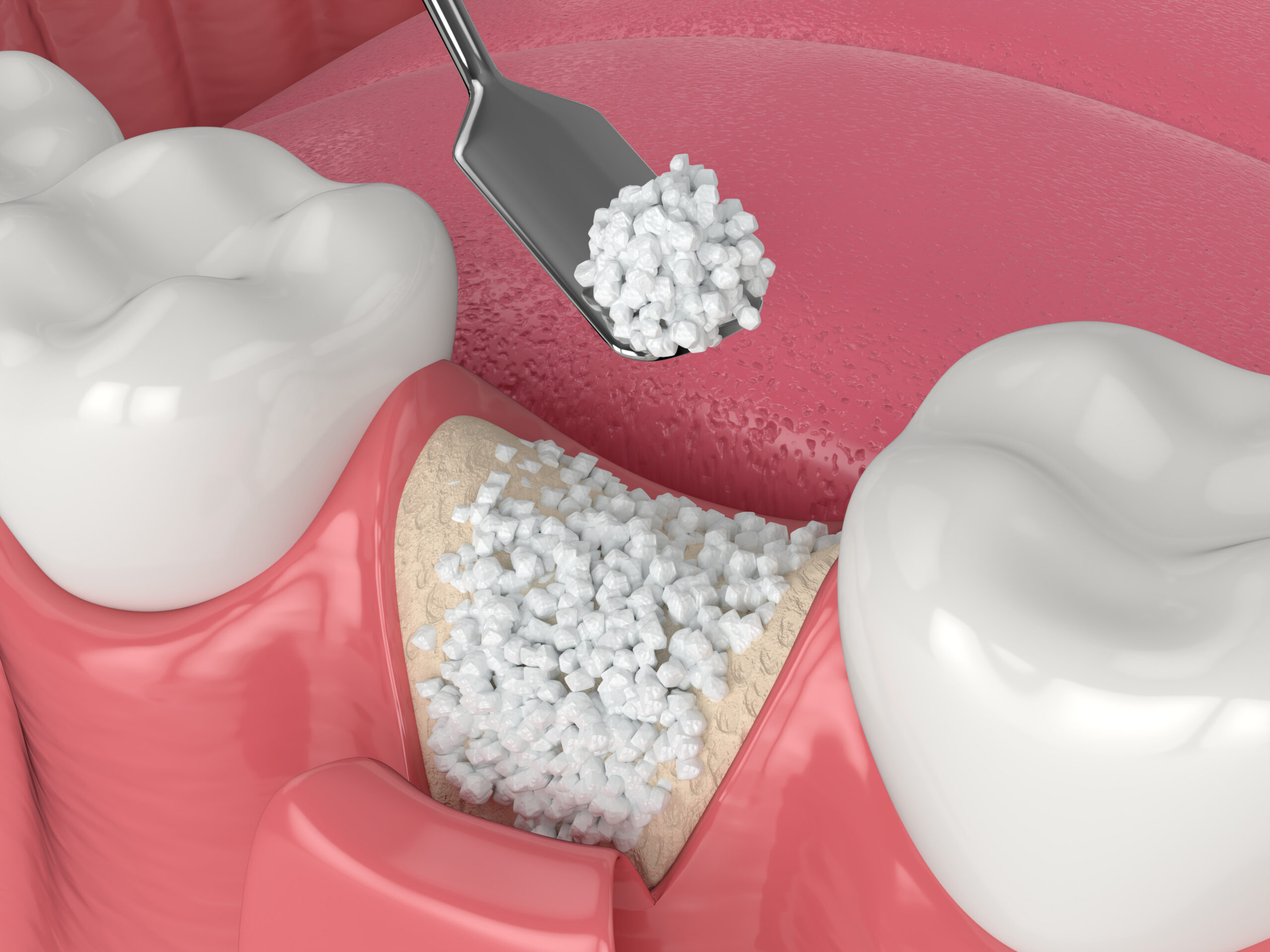 3D render of dental bone grafting with bone biomaterial application over white background. Jaw bone augmentation concept.