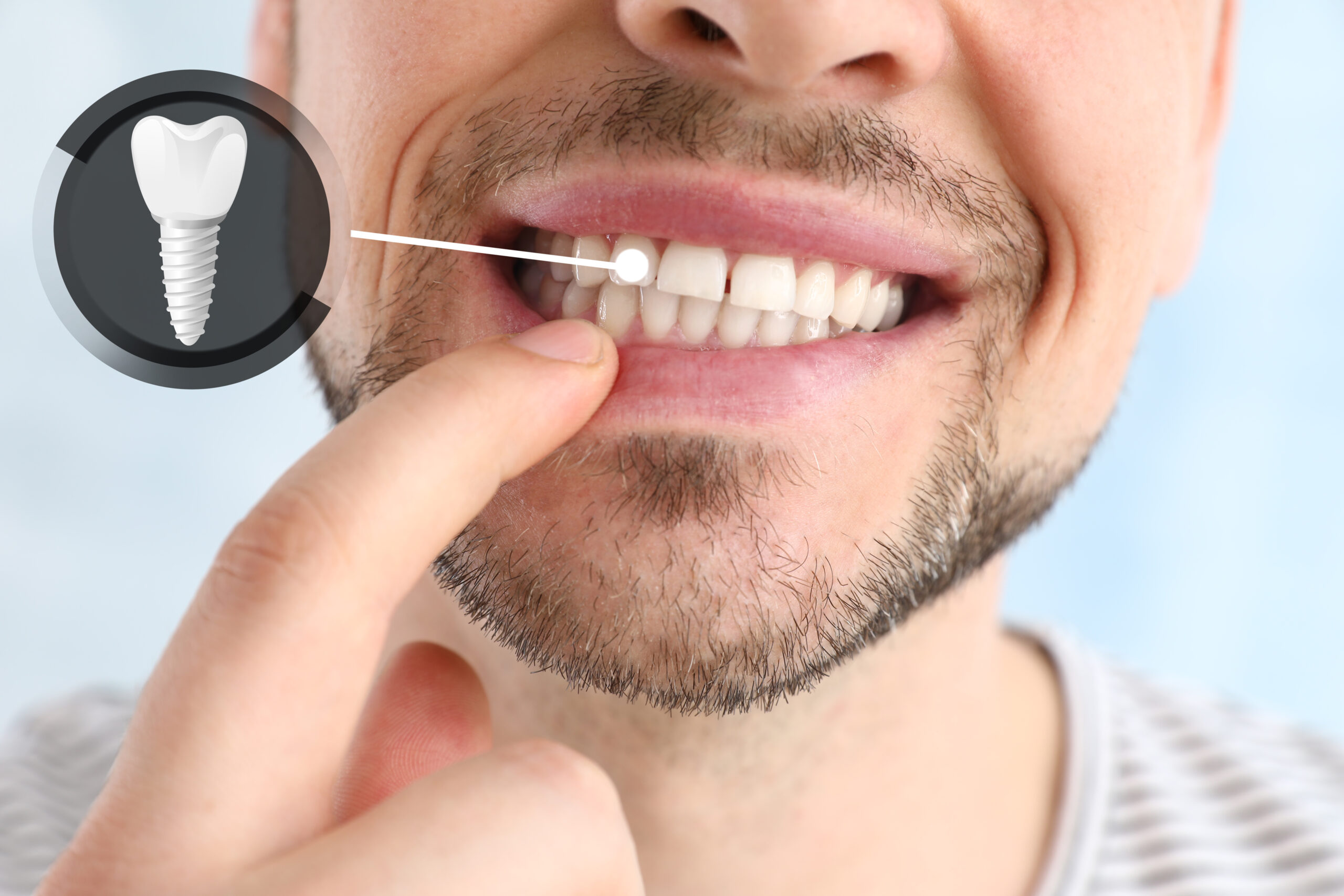 Man showing implanted teeth on light background, closeup