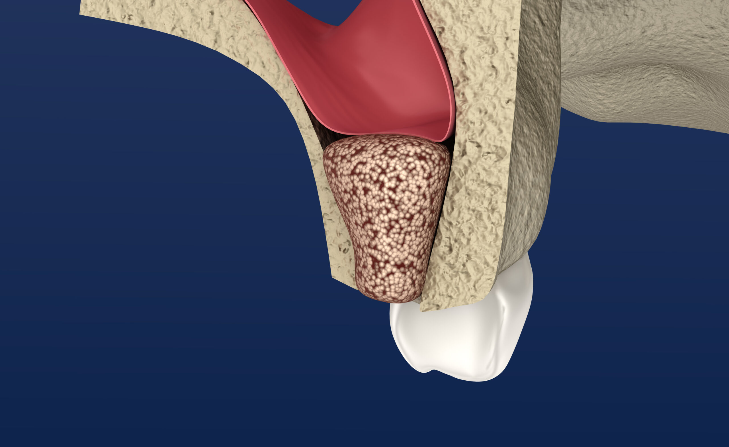 Sinus Lift Surgery - Sinus Augmentation. 3D illustration