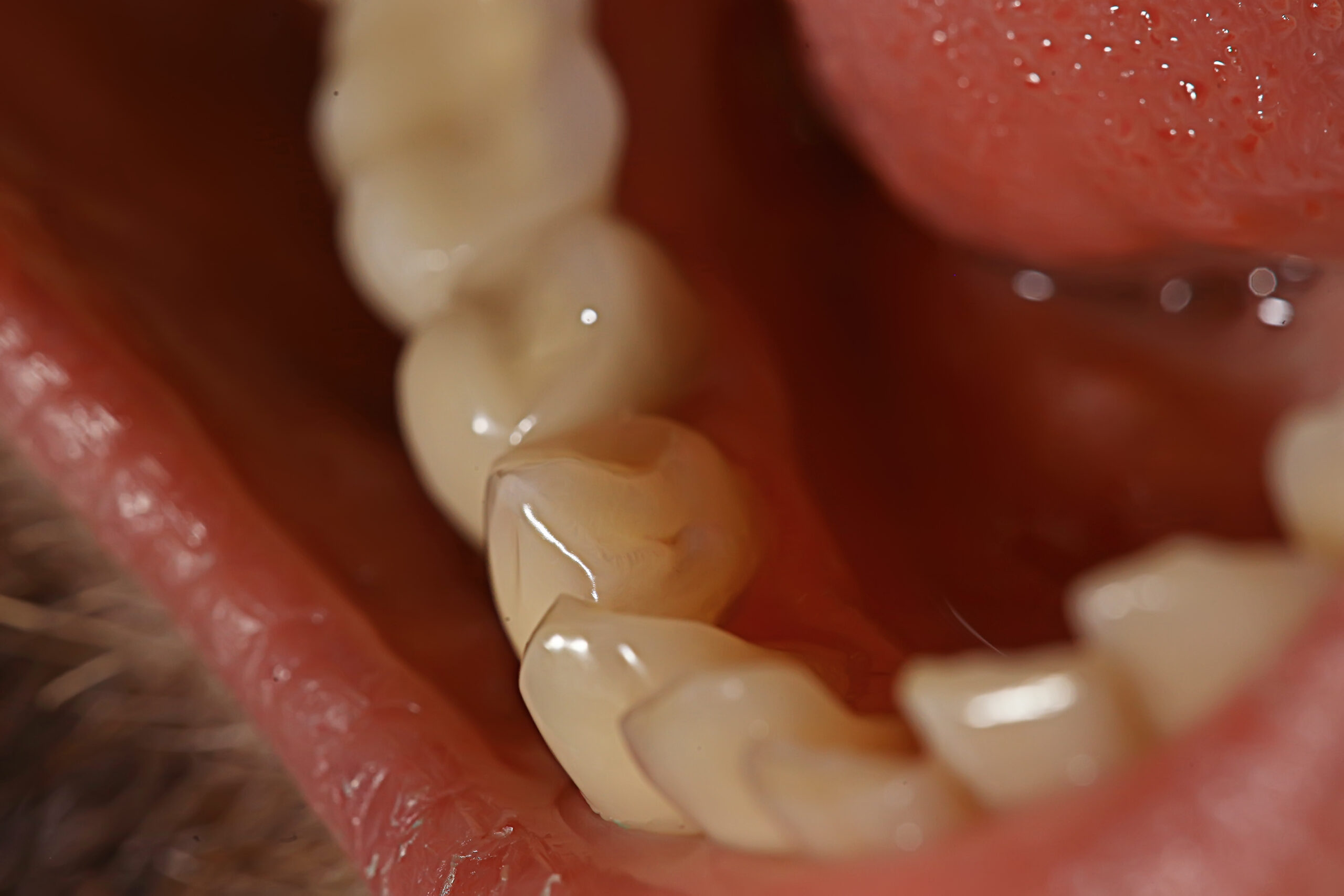 tooth restoration on the pin / dentistry macro, tooth, gum, dental treatment