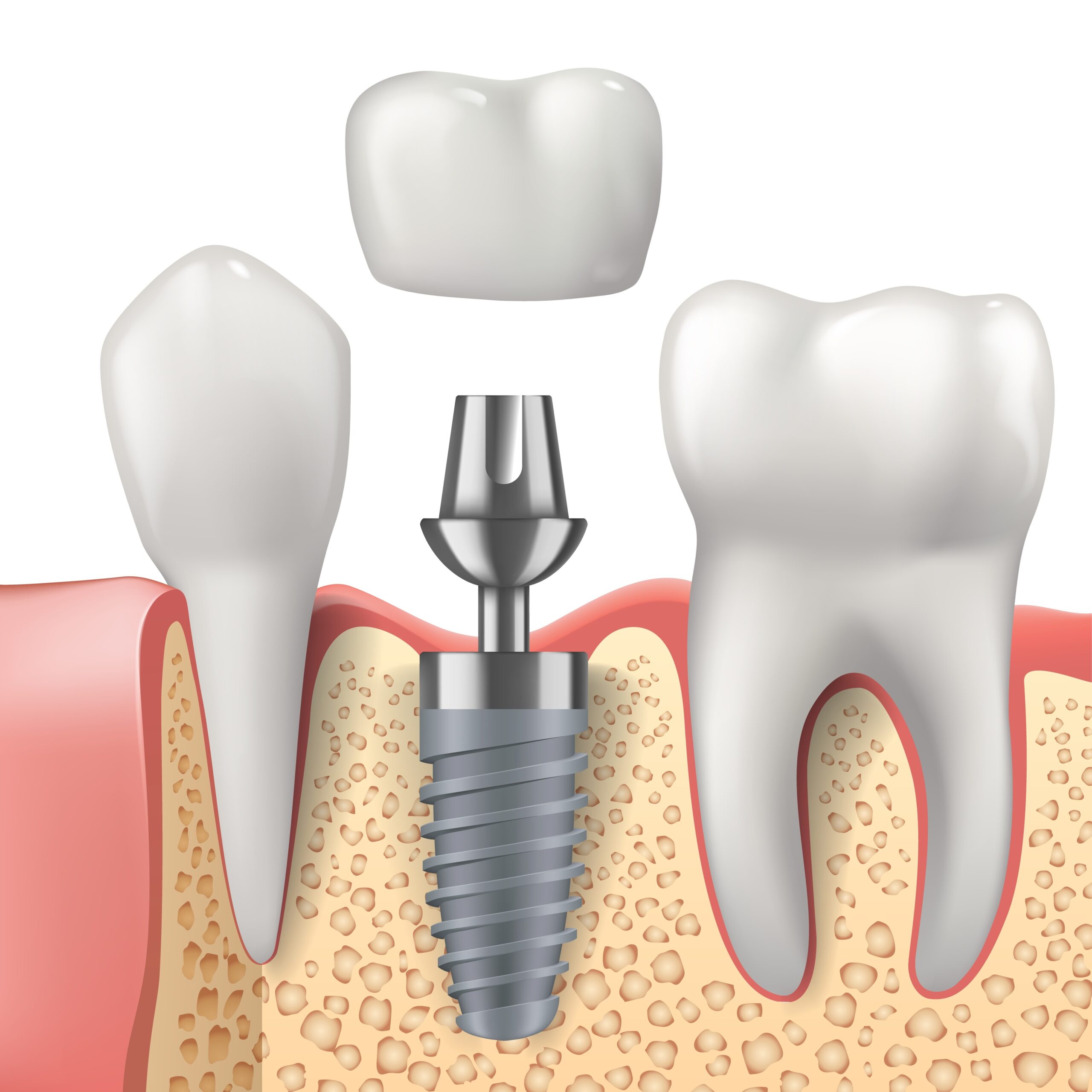 prairie village implant dentistry