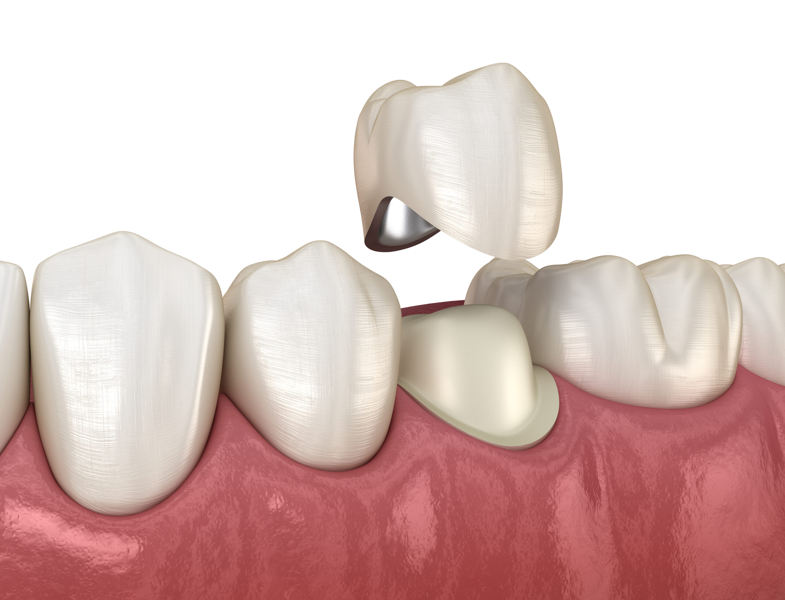 prarie village dental crowns