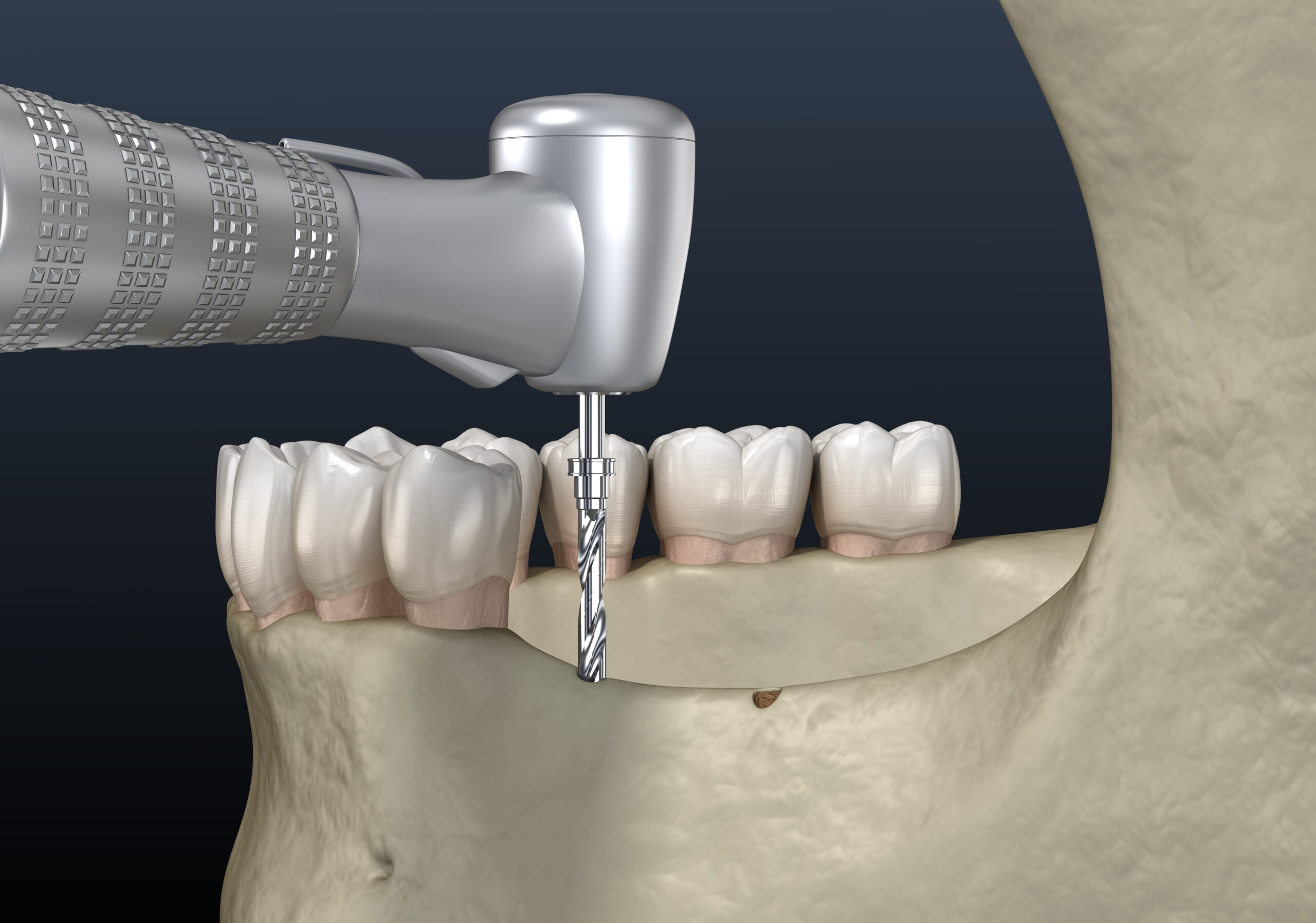 prairie village jaw surgery