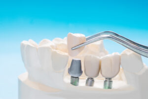 prairie village dental crowns