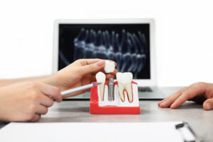 dental implants