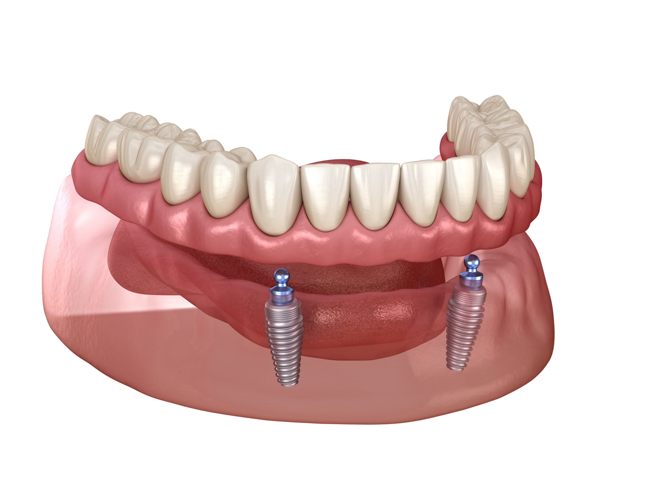 prairie village dental implants