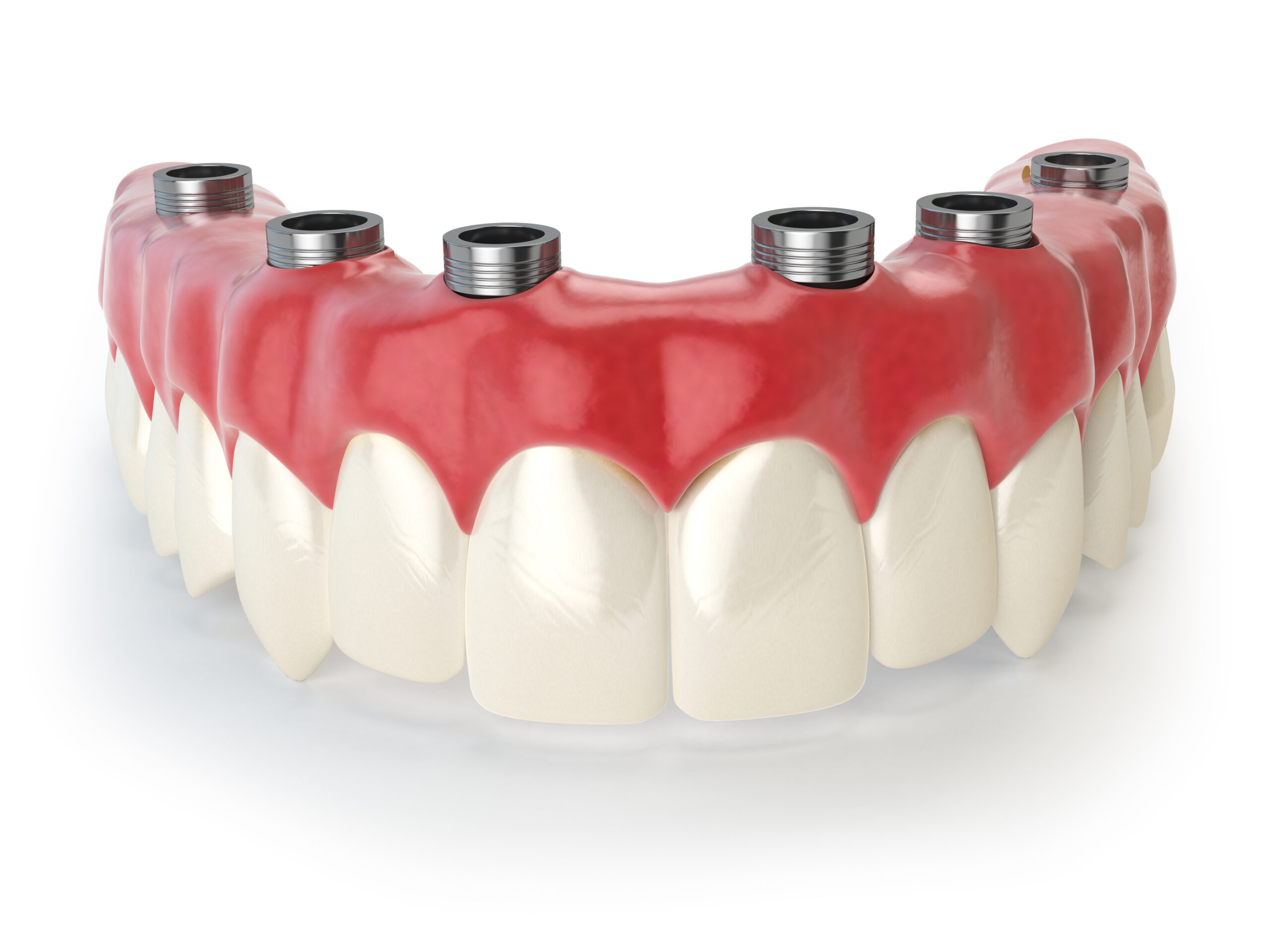 prairie village dental implants